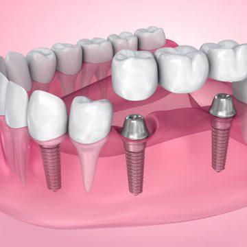 Explore the Benefits of Dental Bridges