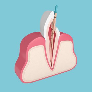 How Root Canal Treatment Can Save Cracked or Damaged Teeth