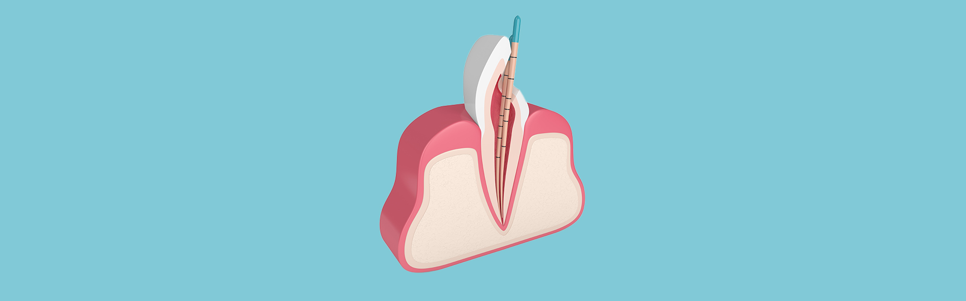 How Root Canal Treatment Can Save Cracked or Damaged Teeth