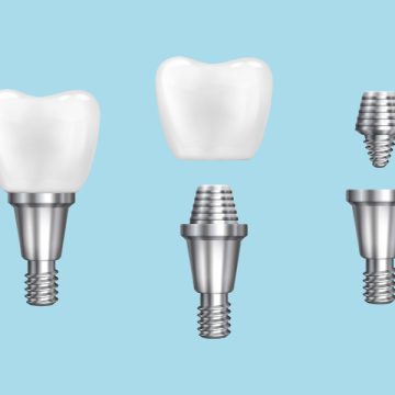 Why Are Dental Implants Considered a Long-Term Solution?